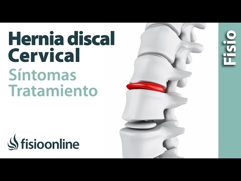 Vídeo: Hernia De La Columna Cervical: Síntomas, Causas Y Tratamiento