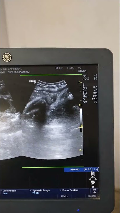 Death Fetus ( iufd ). Ultrasound