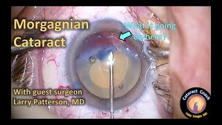 Surgical Approach for Morgagnian Cataracts