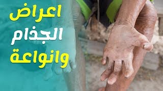 اعراض وانواع مرض الجذام وطرق علاجه والوقاية منه - البرص