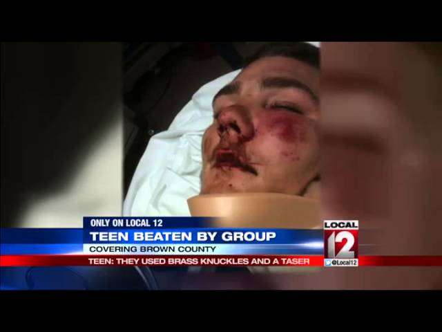 Teen beaten by group with brass knuckles and taser
