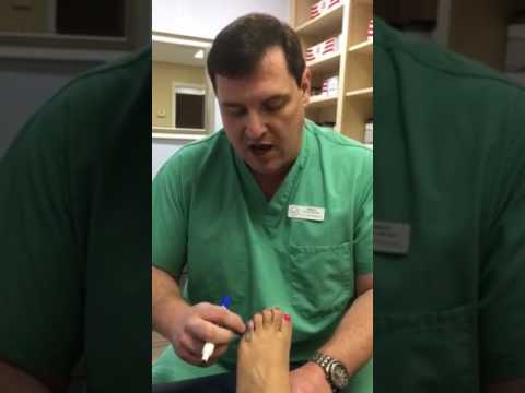 Video: Pinky Toe Brudt, Brudt Eller Forstuvet? Symptomer Og Behandling