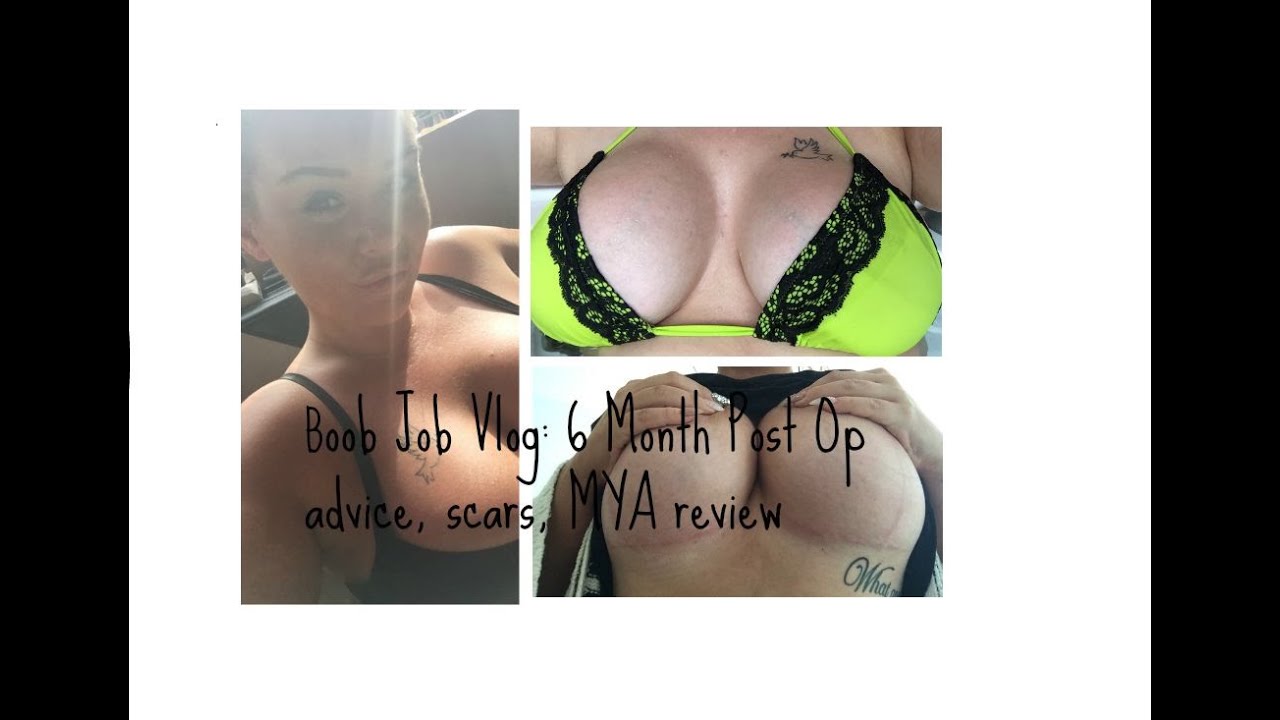 Boob Job Vlog 4: 6 Months Post Op, Mastopexy, Scarring, Surgery Review ♡  SophieBBeauty 