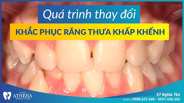 Niềng răng mắc cài kim loại - khắc phục răng thưa khấp khểnh | Nha khoa quốc tế Athena