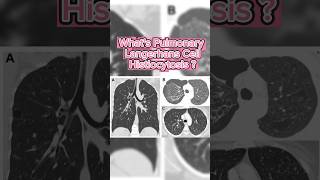 What's Pulmonary Langerhans Cell Histiocytosis #shorts #pulmonary #short  #lungs