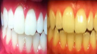 تبييض الاسنان  خلطة-طبيعية -مضمونة ??