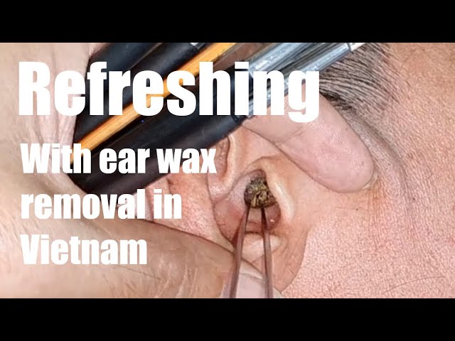 Removal of the Golden Earwax