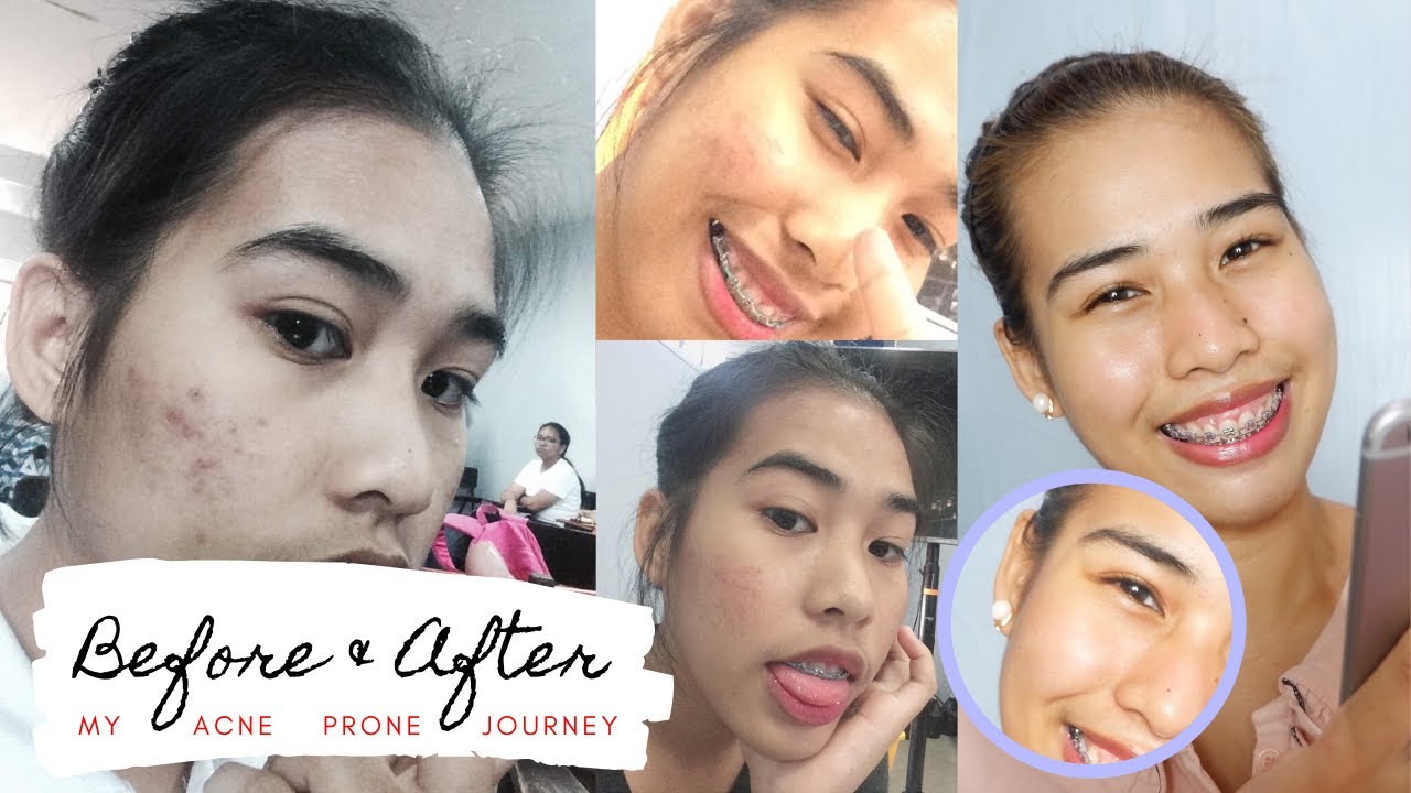 HOW I CLEAR MY SKIN (MY ACNE JOURNEY) | What actually works... - YouTube