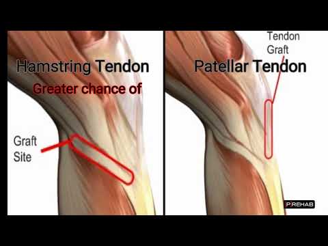 ACL Reconstruction Graft Options