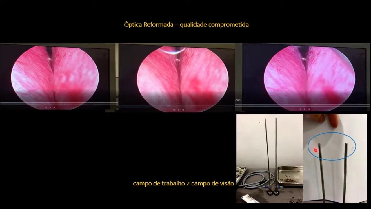 Reunião Clínica de Urologia Prevenir Complicações na Ressecção Endoscópica da Próstata Reunião Clínica de Urologia Prevenir Complicações na Ressecção Endoscópica da Próstata