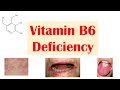 Vitamin b6 pyridoxine deficiency  dietary sources causes signs  symptoms diagnosis treatment
