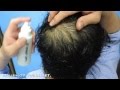 チャップアップ育毛動画94日目。冷蔵庫で冷やしておいた育毛剤のスプレーが心地よく毛穴に沁み込んでいきます。2015.5.24