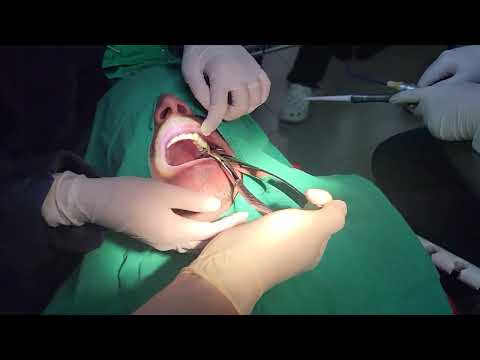 how to use forceps properly to extract upper 3rd molars -from my Mexico Live Surgery Course