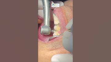 BÓC TRẦN lý do phải MÀI RĂNG trước khi làm RĂNG SỨ #benhvienjw