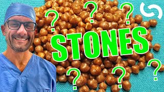 Gallstones  What you need to know!