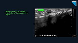 Breast Imaging Challenging Cases | Free Radiology CME