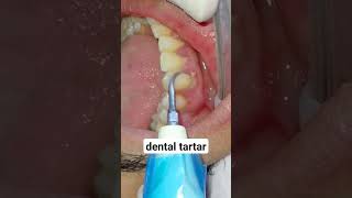 جير االاسنان||dental  tartar||dental scaling