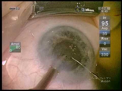 cataract parkinson head 45  inclined