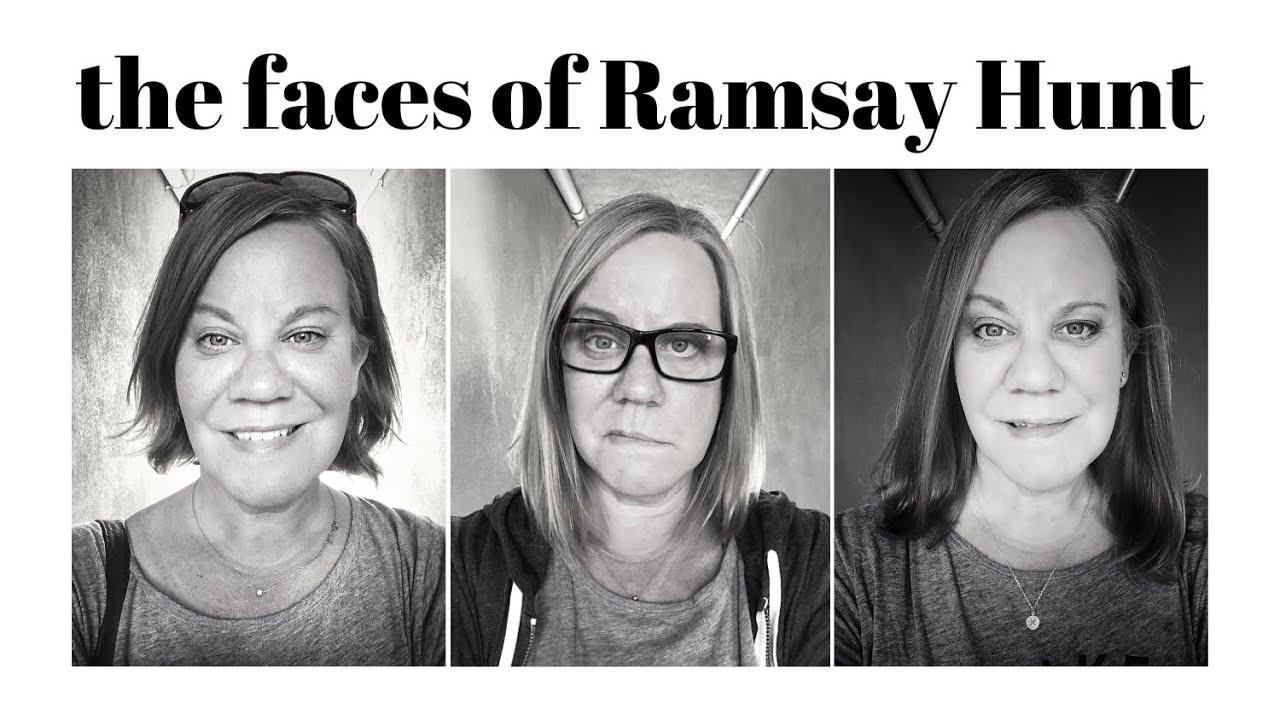 Frustrations of Ramsay Hunt Syndrome Recovery, Day 125, Small Changes