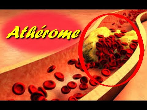Vidéo: Athérosclérose De L'aorte Abdominale - Symptômes Et Traitement