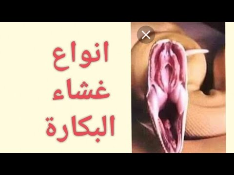 شكل غشاء البكارة