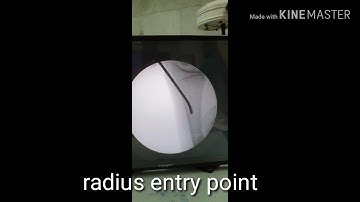 Both Bone Forearm Fracture in 13-Year-Old | Titanium Elastic Nailing (TENS) (Orthopedic Surgery)