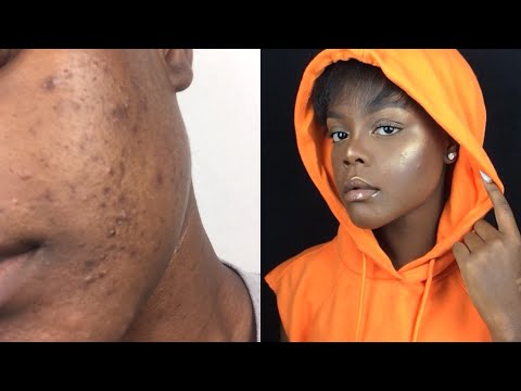No Foundation "No Makeup" Makeup Tutorial For Acne Prone Skin