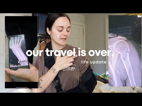 i broke my arm