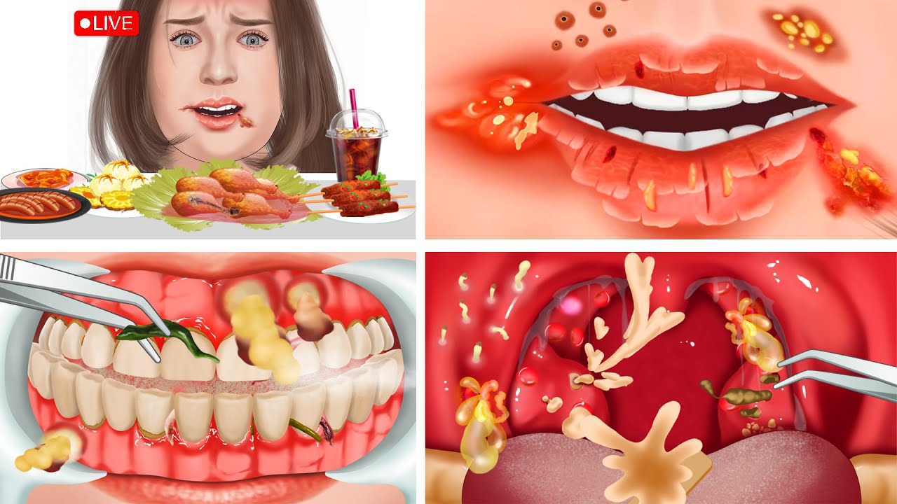 ASMR The best treatment mouth blisters, tonsil stones, swollen gums