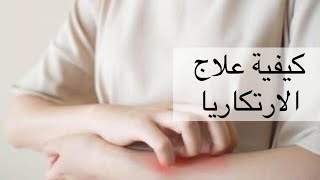 كيفية علاج الارتكاريا