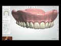 Stratasys Academy | Conception de prothèse copiée dans 3Shape pour TrueDent
