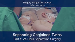Separating Conjoined Twins Part 4: 24-Hour Separation Surgery (surgery images not blurred)