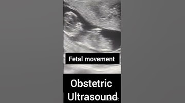 Ultrasound showing cardiac activity and movement!Pregnancy ultrasound!Early Pregnancy Scan#radiology