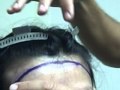 Plastic Surgeon Dr. Jeffrey Epstein - Female Asian Patient - More Oval Hairline - Part 1