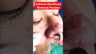 There Is Something Wrong - EXTREME BLACKHEAD REMOVAL shorts