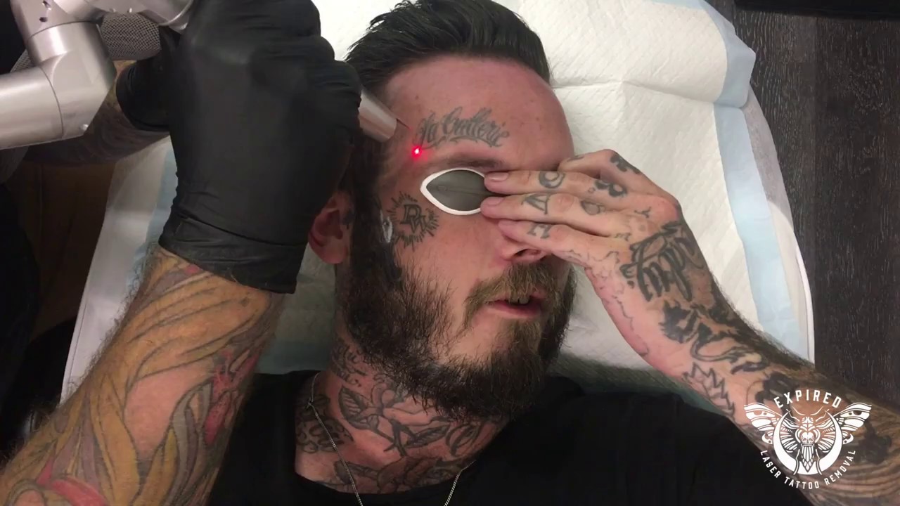FACE TATTOO REMOVAL | EXPIRED LASER STUDIO - YouTube