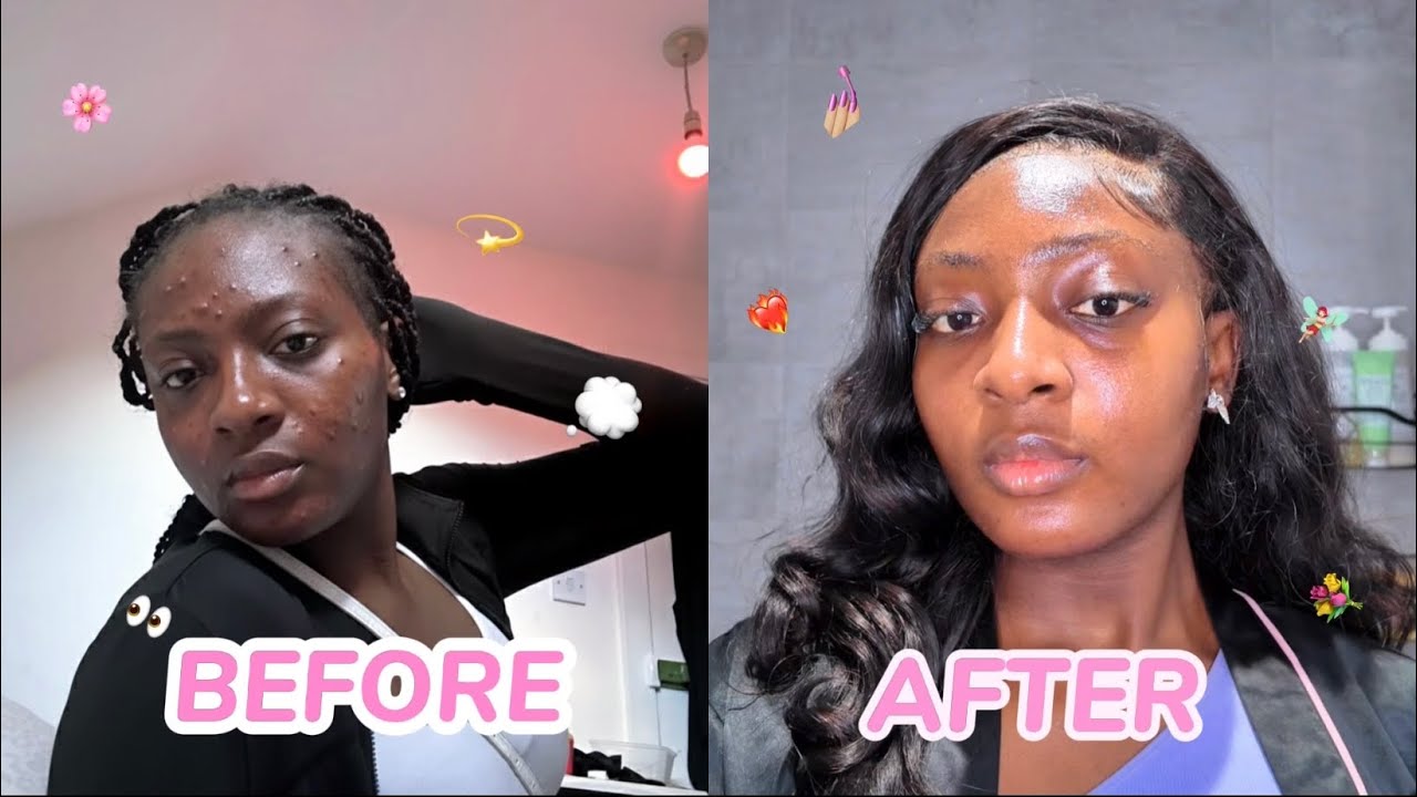 How I Cleared My Acne + Dark Spots + Hyperpigmentation for good (step ...