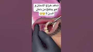ايه ال بيحصل ل خراج الاسنان لما ننفخه من داخل السن Smiledentist Explore Smileexpertz 