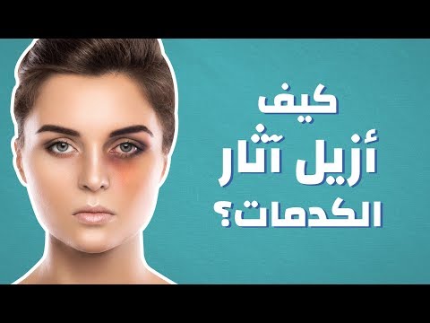 فيديو: 3 طرق لإزالة الكدمة بشكل أسرع