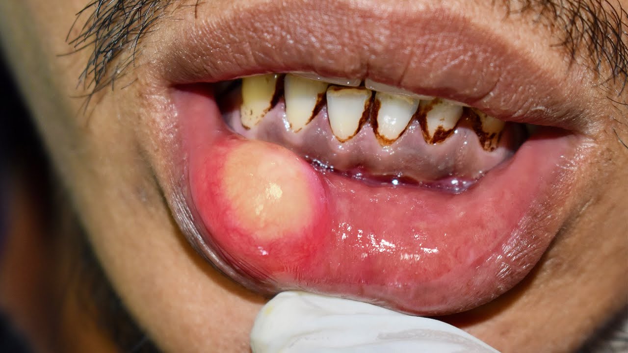 Ydeevne smeltet opretholde Should This Cyst Be Popped? How To Remove An Oral Mucocele - YouTube