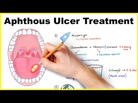 Aphthous ulcer/ stomatitis/ Canker sore  treatment