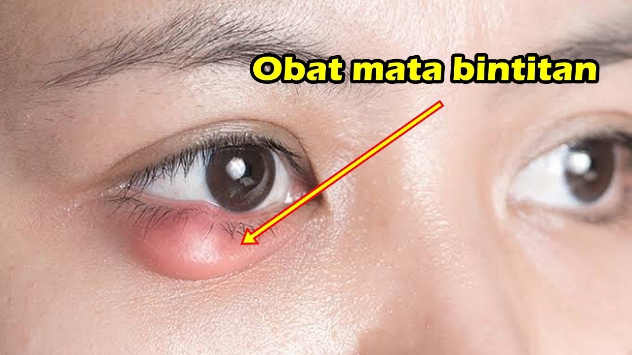 Cara Mengatasi Mata Bintitan dengan Cepat