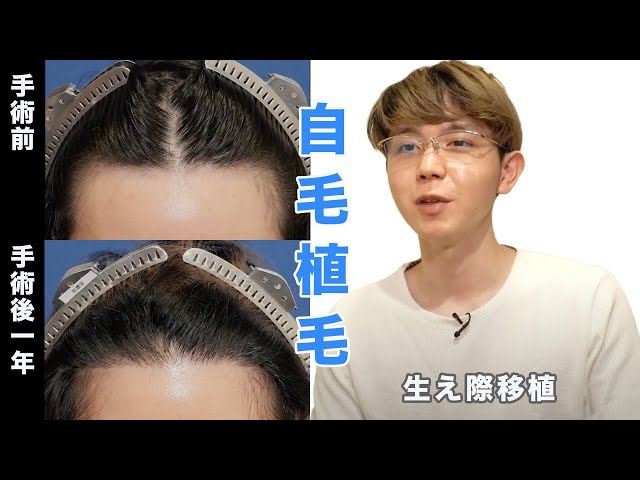 1 Year Post-Hair Transplant] Interview with a patient who received