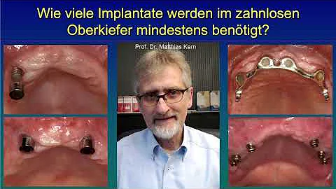 Wie viele Implantate Gleichzeitig setzen?