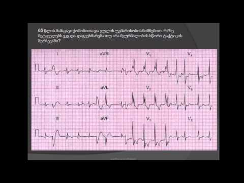 ეკგ / პოლიტოპური პარკუჭოვანი ექსტრასისტოლია / პოლიტოპური ექსტრასისტოლები / გულის იშემიური დაავადება