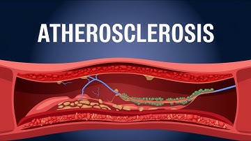 Atherosclerosis animation |understanding Atherosclerosis