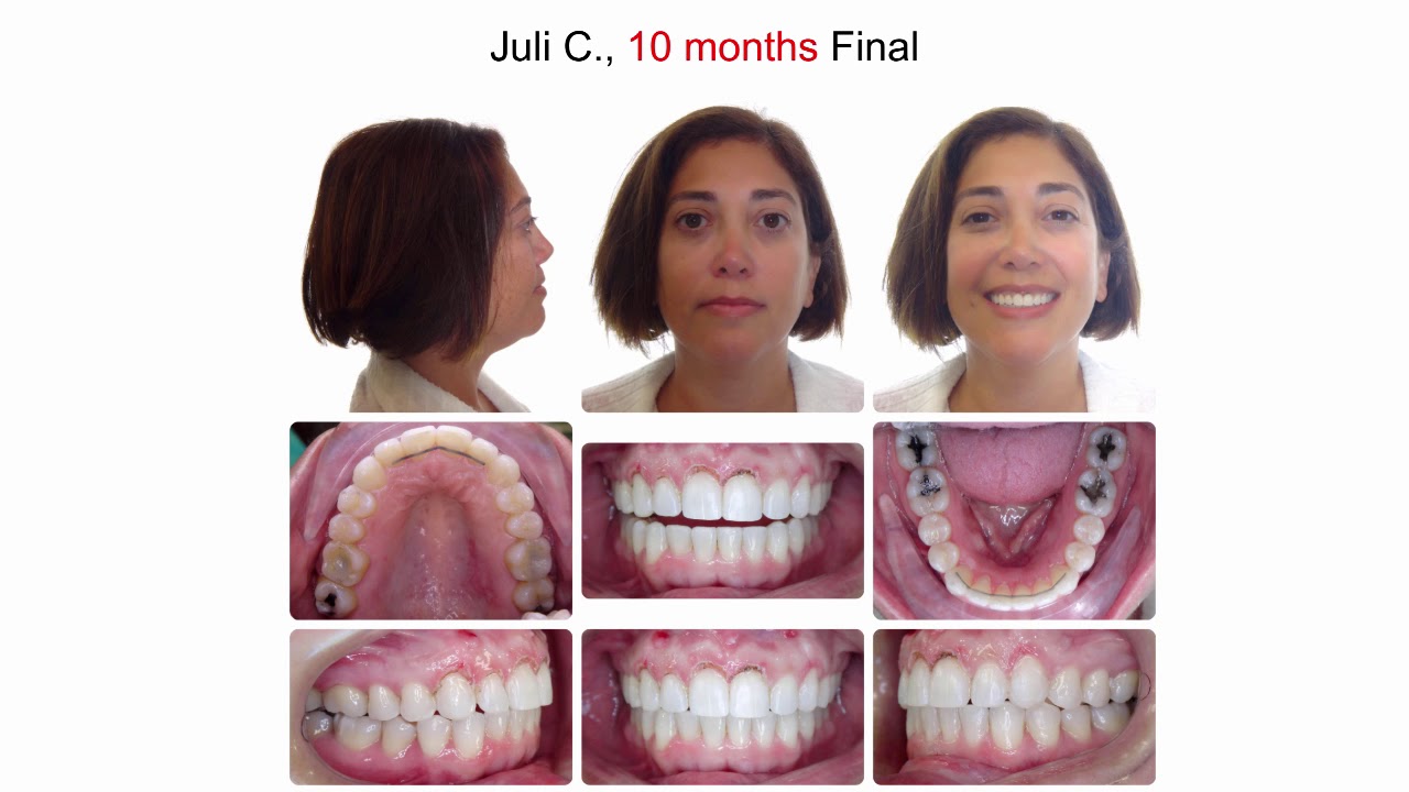 Dr  Jasmine Gorton AcceleDent, TADs & 7 Day Aligner Changes