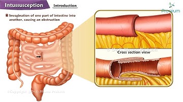 Intussusception: Clinical presentation, Radiological investigations, Management: Surgery