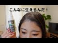 半年間毎日ミノキシジルを使い続けた結果がこちら！