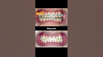 Cận cảnh quá trình thay đổi răng móm